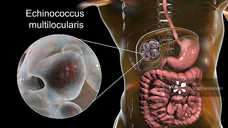 肝脏包虫病，泡型包虫病，图示图片素材
