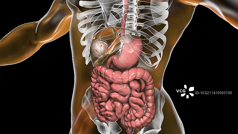 肝脏包虫病，囊性棘球蚴病图示图片素材