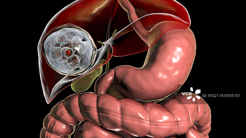 肝脏包虫病，囊性棘球蚴病图示图片素材
