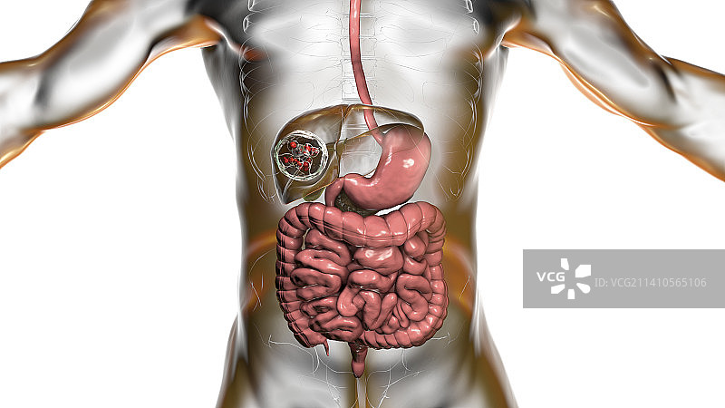 肝脏包虫病，囊性棘球蚴病图示图片素材