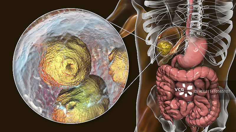 肝脏包虫病，囊性棘球蚴病图示图片素材
