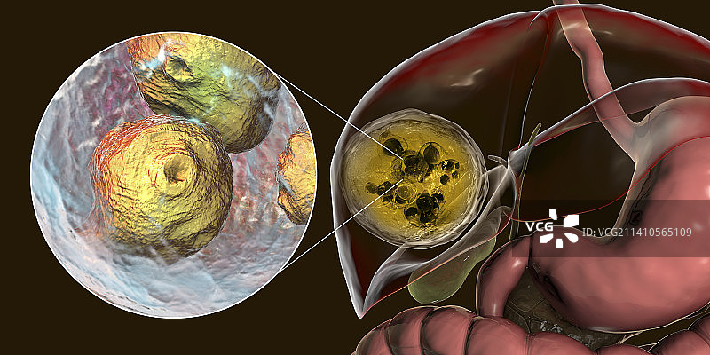 肝脏包虫病，囊性棘球蚴病图示图片素材