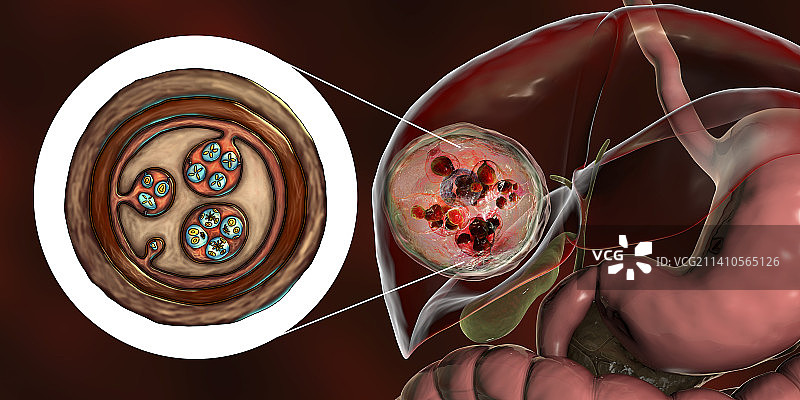肝脏包虫病，囊性棘球蚴病图示图片素材