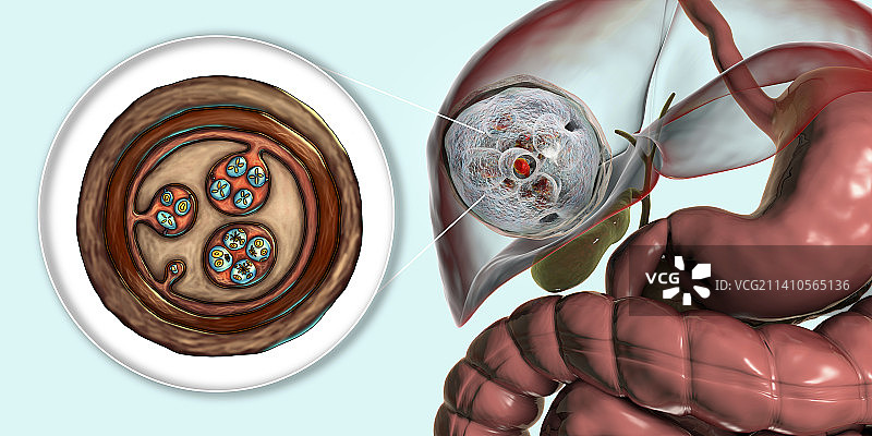 肝脏包虫病，囊性棘球蚴病图示图片素材