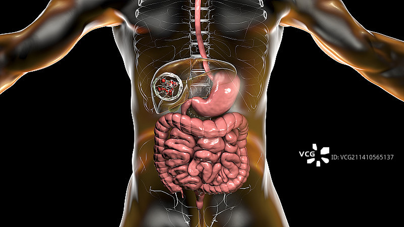 肝脏包虫病，囊性棘球蚴病图示图片素材