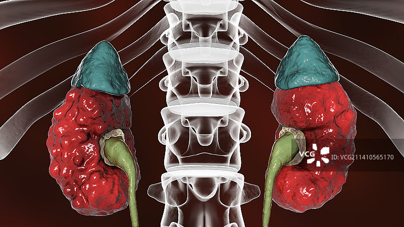 慢性肾盂肾炎插图图片素材