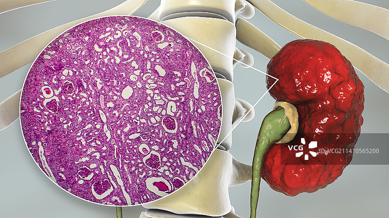 慢性肾盂肾炎，插图和光学显微照片图片素材