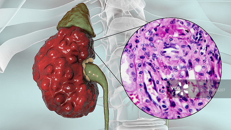 慢性肾盂肾炎，插图和光学显微照片图片素材