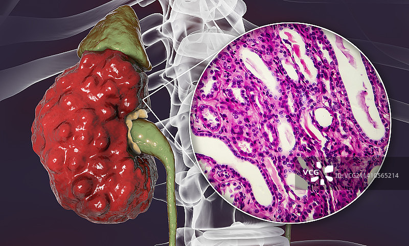 慢性肾盂肾炎，插图和光学显微照片图片素材