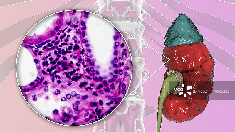 慢性肾盂肾炎，插图和光学显微照片图片素材
