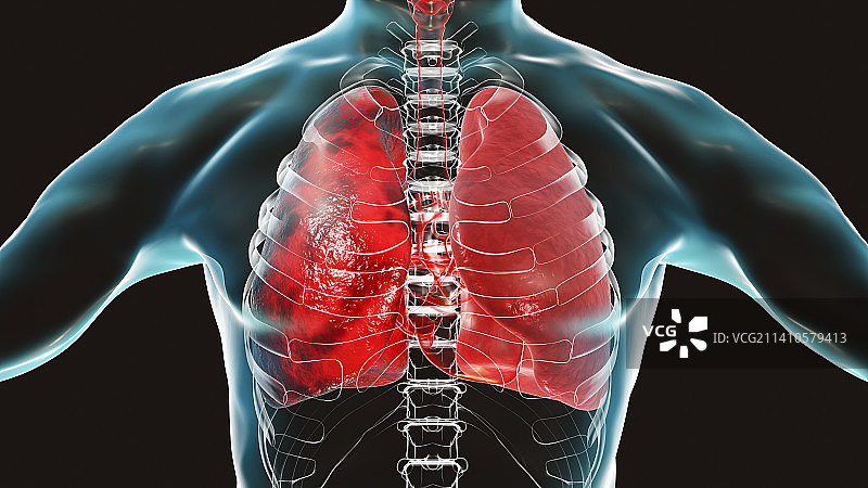 肺炎插图图片素材