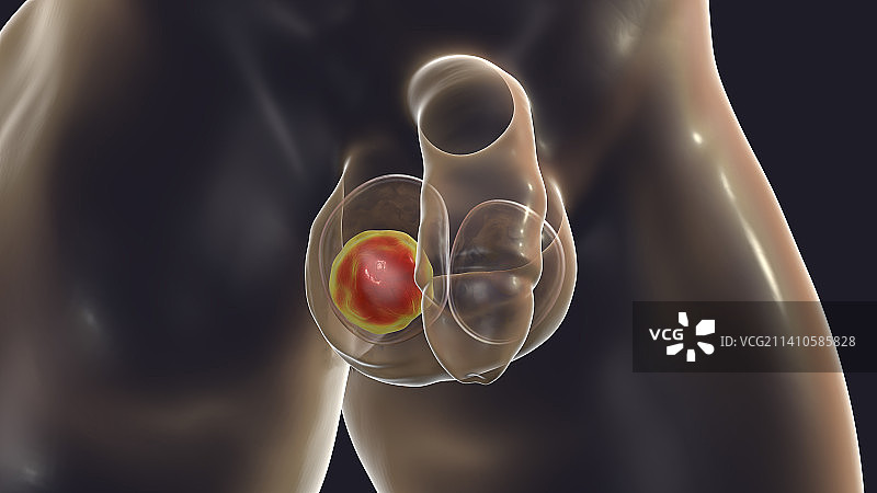 睾丸癌，图示图片素材