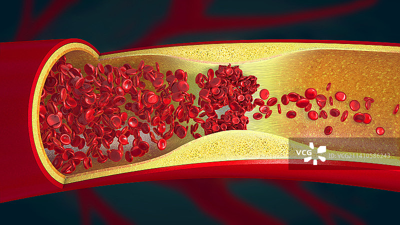 血凝块，插图图片素材