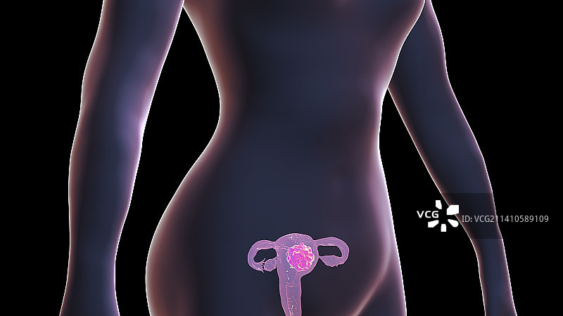 子宫癌概念图图片素材
