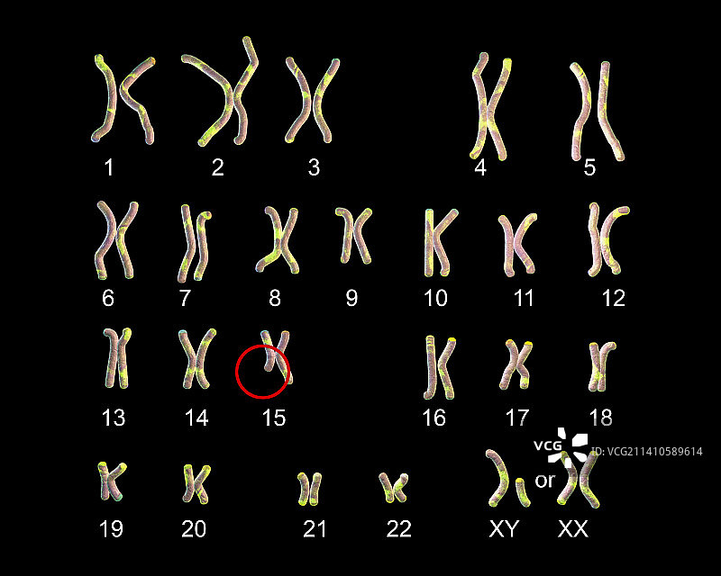 天使综合征的核型图图片素材