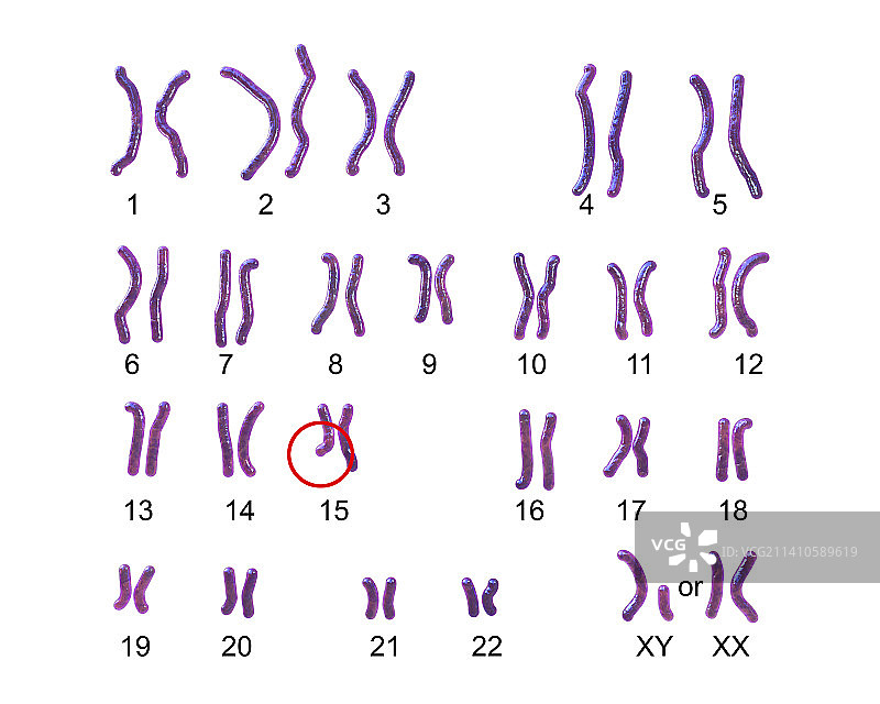 天使综合征的核型图图片素材