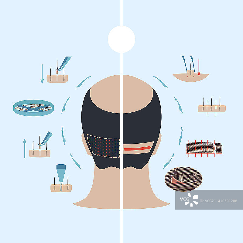 毛囊单位提取术和毛囊单位移植术对比插图图片素材