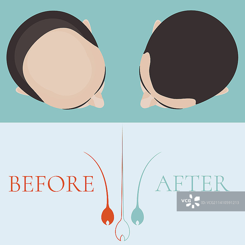 男性脱发治疗概念插图图片素材