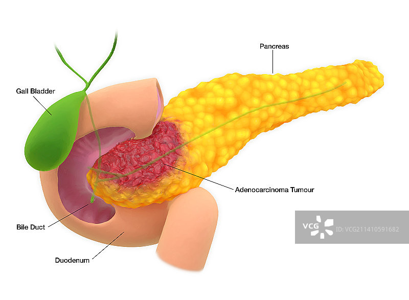 胰腺腺癌插画图片素材