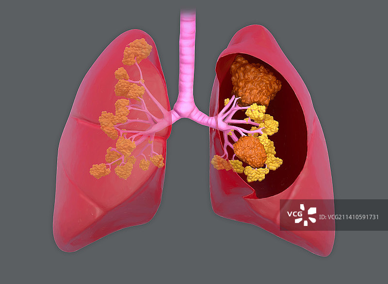 肺癌插图图片素材