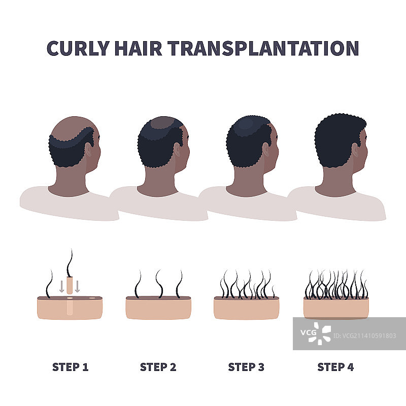 头发移植插图图片素材