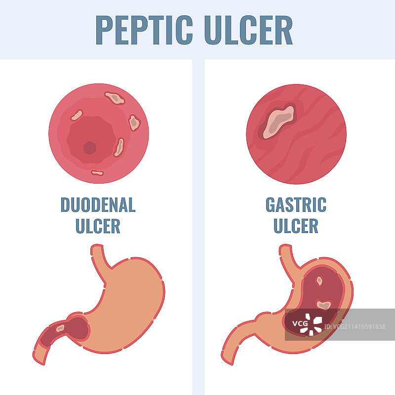 消化性溃疡概念图图片素材