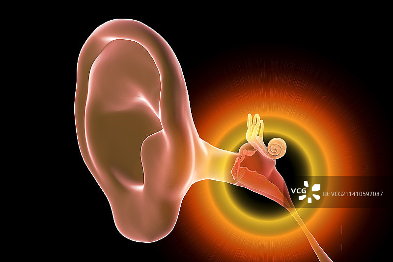 中耳炎耳部感染插图图片素材