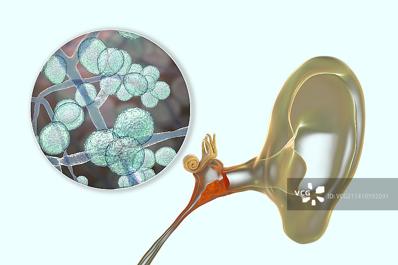 慢性真菌性中耳炎耳部感染插图图片素材