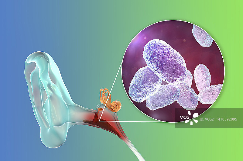中耳炎耳部感染插图图片素材