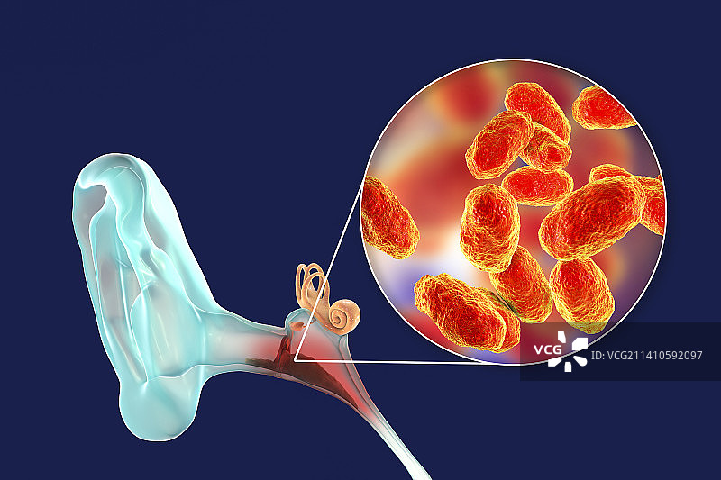 中耳炎耳部感染插图图片素材