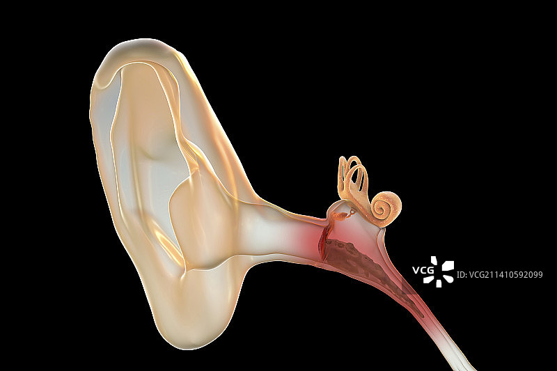 中耳炎耳部感染插图图片素材