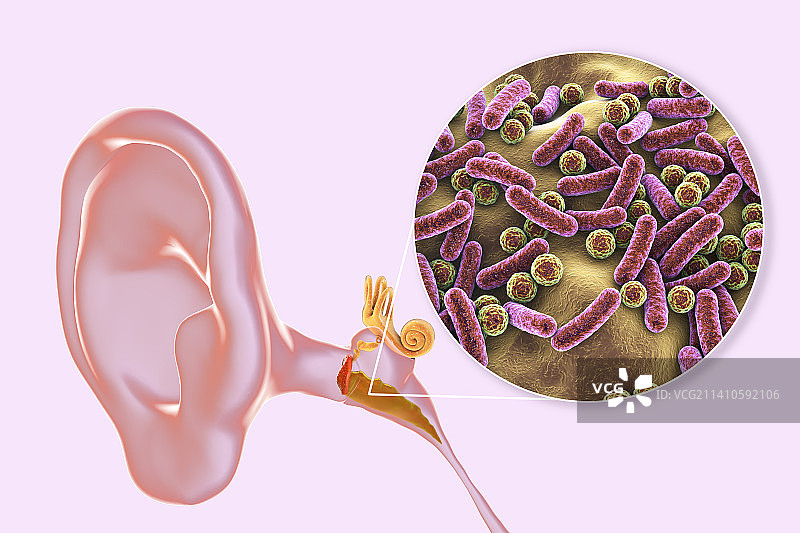 中耳炎耳部感染插图图片素材