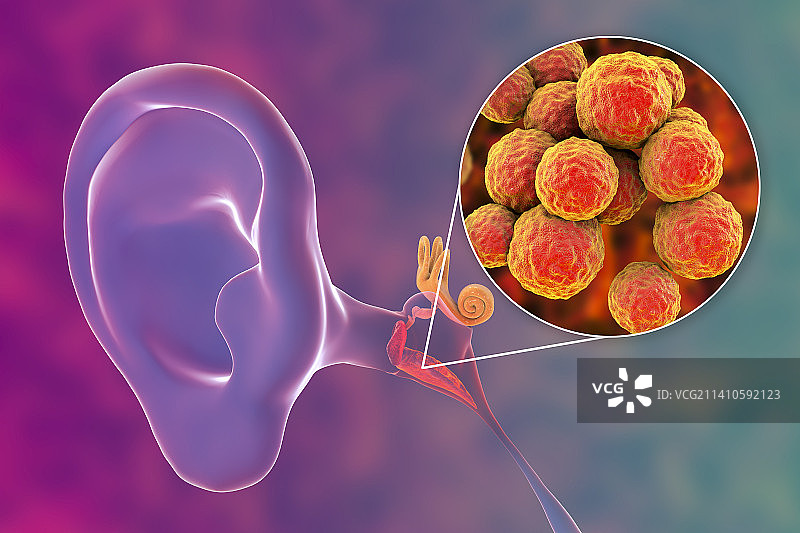 中耳炎耳部感染插图图片素材