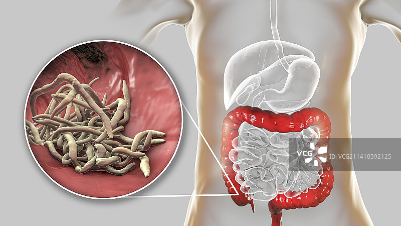 人类大肠中的蛔虫插画图片素材