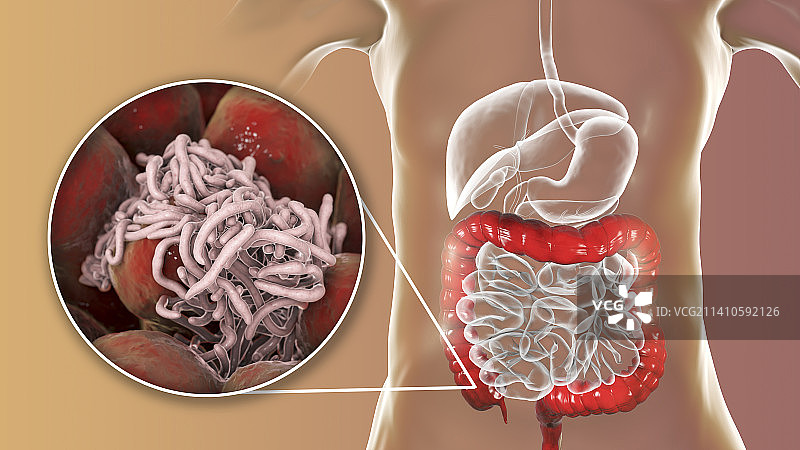 人类大肠中的蛔虫插画图片素材