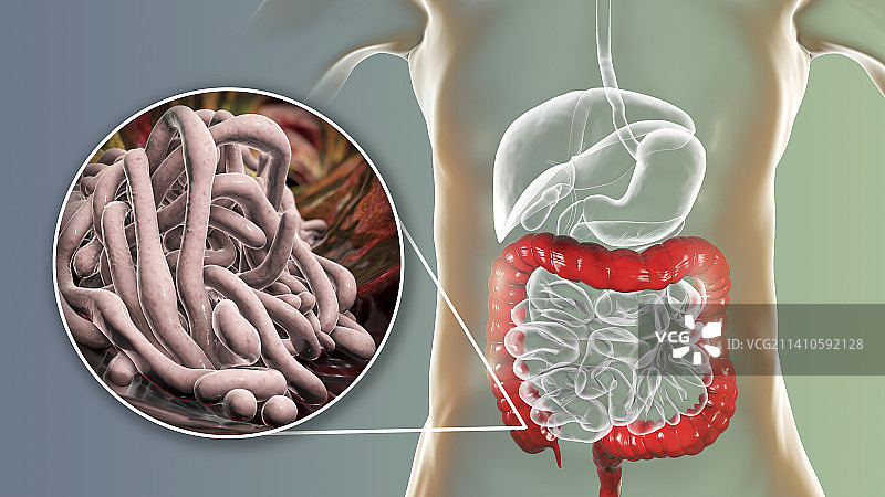 人类大肠中的蛔虫插画图片素材