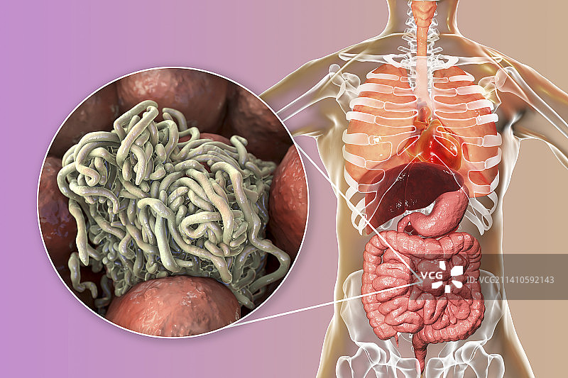 人肠道内的蛔虫，图示图片素材