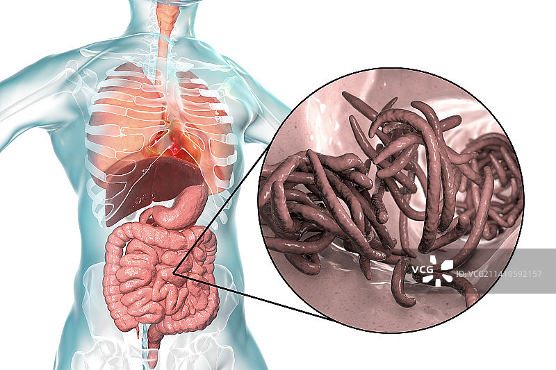 人肠道内的蛔虫，图示图片素材