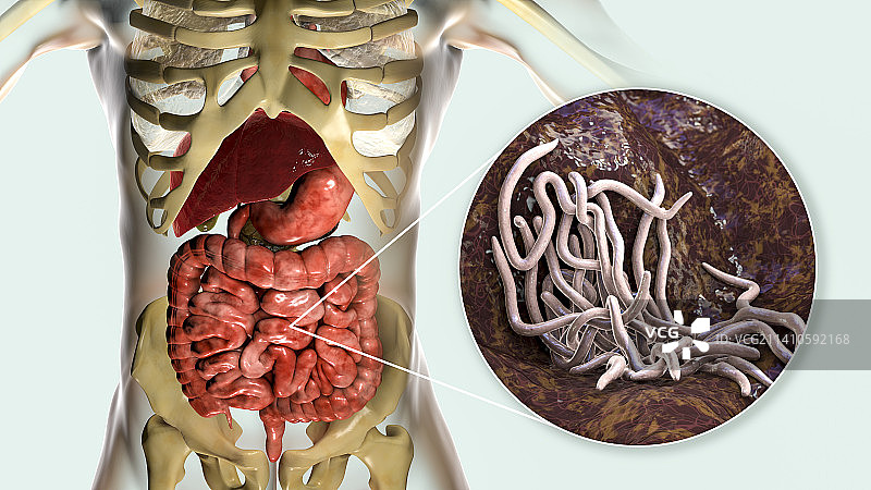 人肠道内的蛔虫，图示图片素材