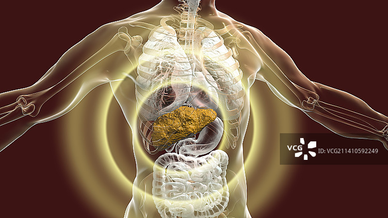 肝硬化插图图片素材