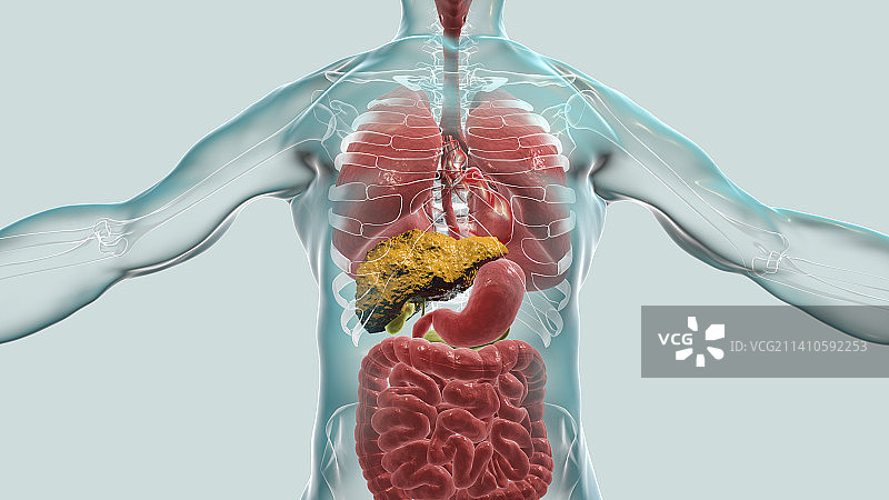 肝硬化插图图片素材