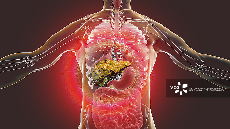 肝硬化插图图片素材