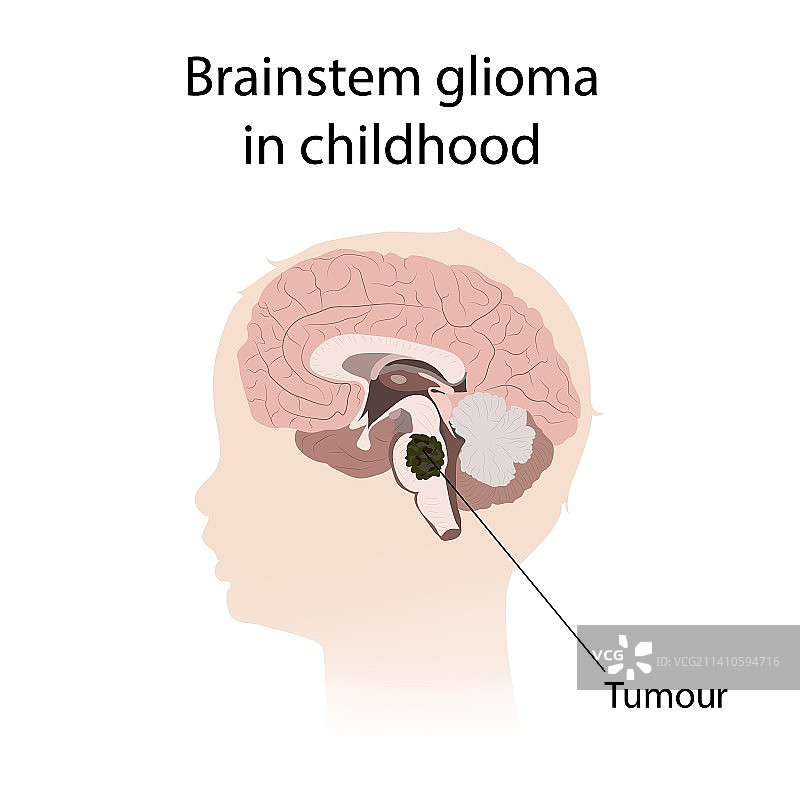 儿童期脑干神经胶质瘤插图图片素材