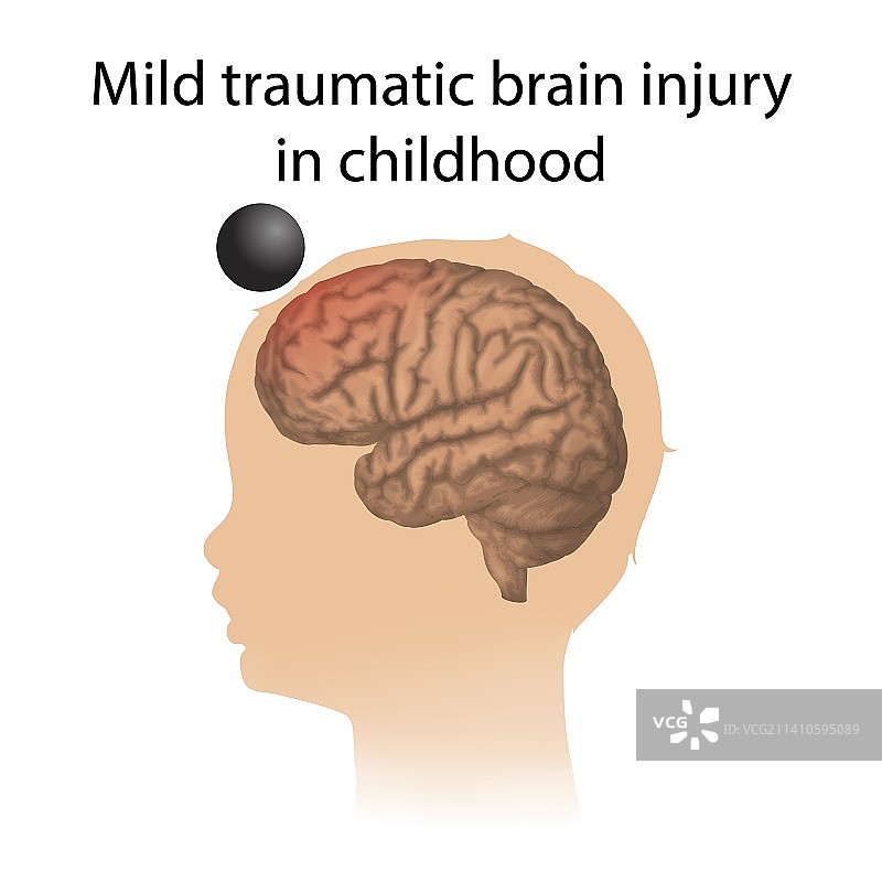 儿童时期轻度外伤性脑损伤插图图片素材