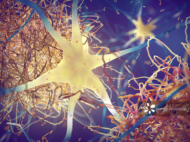 阿尔茨海默病中的淀粉样斑块插图图片素材