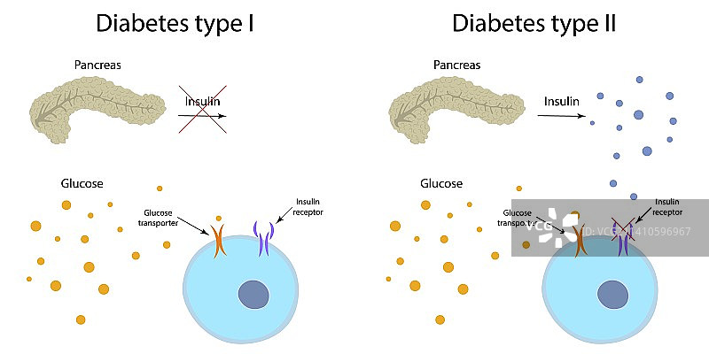 1型和2型糖尿病插图图片素材