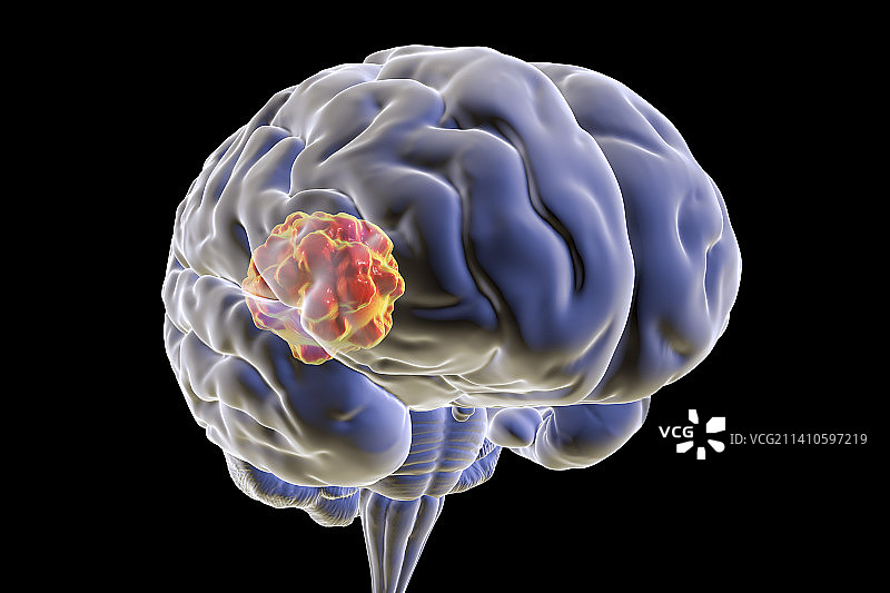 毛霉菌病大脑图示图片素材