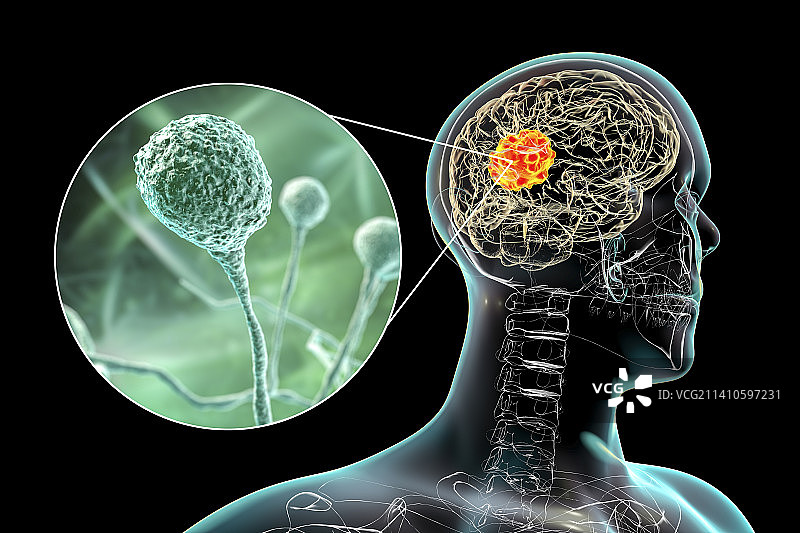 毛霉菌病大脑图示图片素材