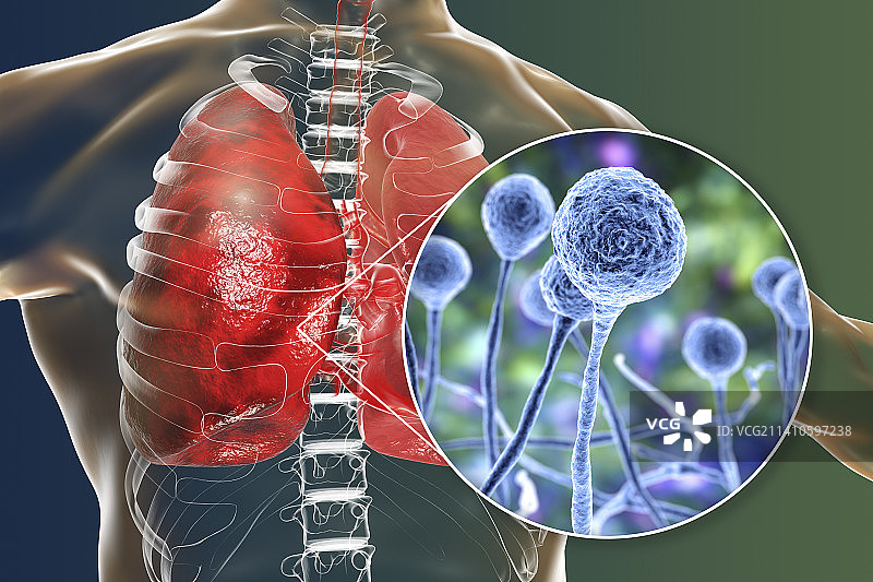 肺毛霉菌病插图图片素材