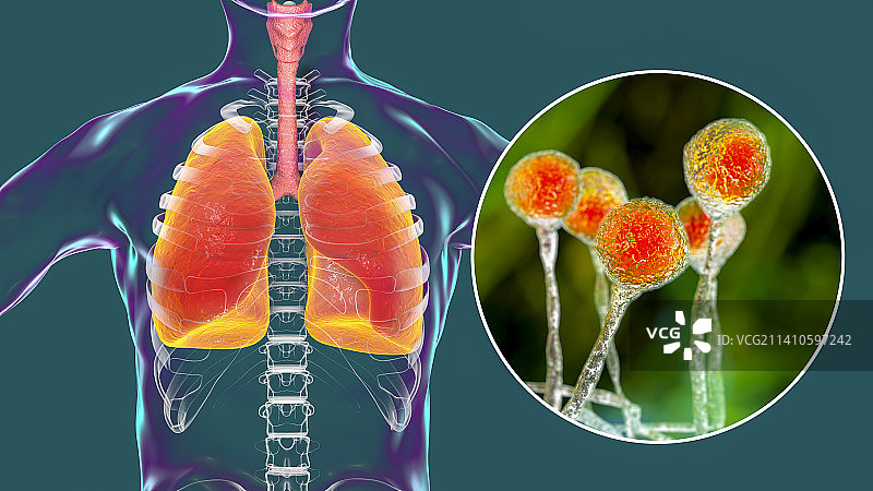 肺毛霉菌病插图图片素材